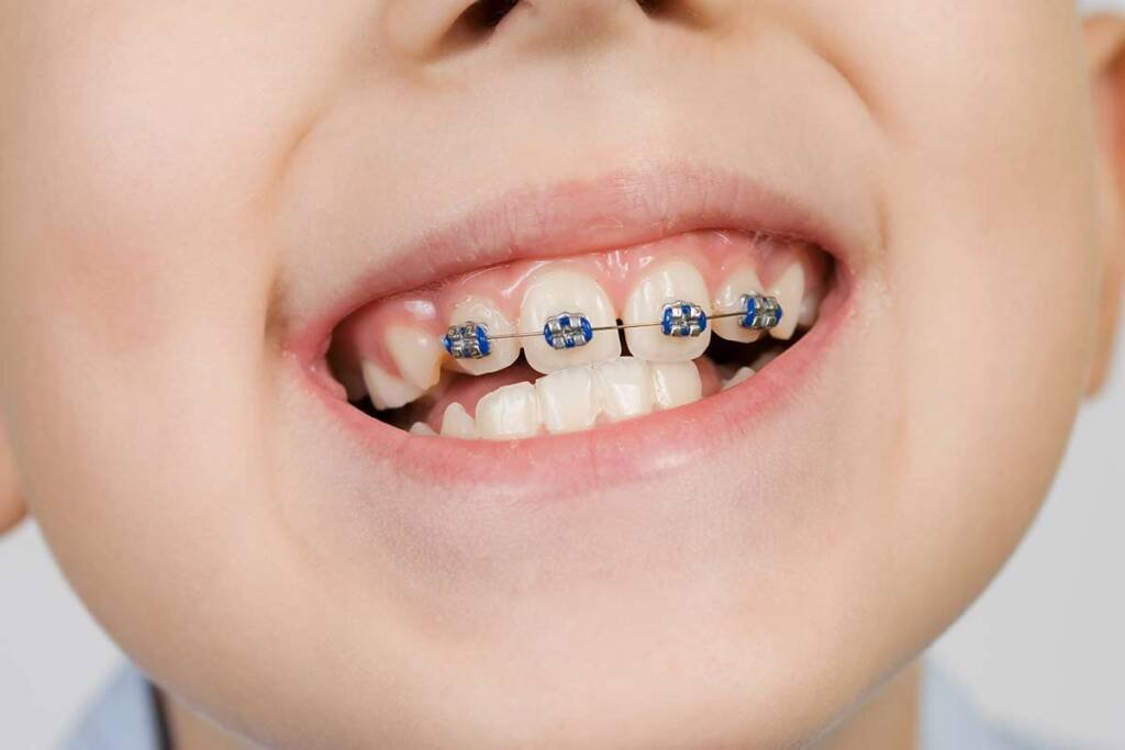 Dental Braces