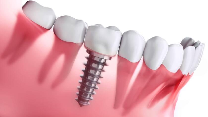 dental implants